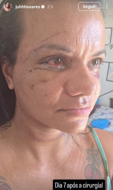 image-251 🚨 BRASIL EM CHOQUE: Mulher que levou MAIS DE 60 SOCOS mostra o rosto pela primeira vez após cirurgia e revela luta pela vida! 😢💔