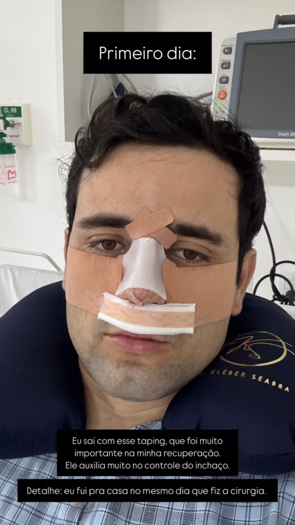 image-295-576x1024 Ex-BBB Matteus Amaral revoluciona o visual e a saúde com rinoplastia: “Antes, eu mal respirava, agora é vida nova!”