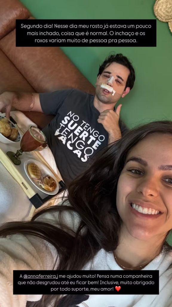 image-296-576x1024 Ex-BBB Matteus Amaral revoluciona o visual e a saúde com rinoplastia: “Antes, eu mal respirava, agora é vida nova!”