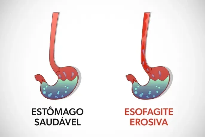 image-497 Saúde de Bolsonaro: médicos revelam quadro delicado e detalham riscos de esofagite e obstruções intestinais