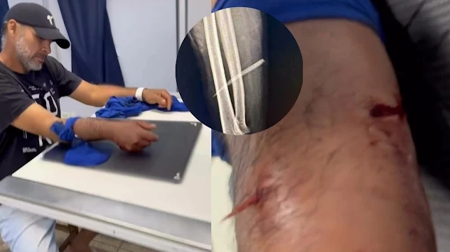 image-353 Pescador pode perder o braço após ser ferroado por peixe no Rio Aquidauana