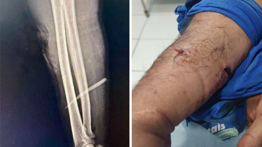 image-354 Pescador pode perder o braço após ser ferroado por peixe no Rio Aquidauana